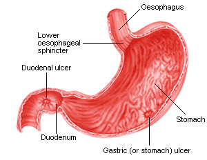 Gastrite - Malattia dell'apparatato digerente